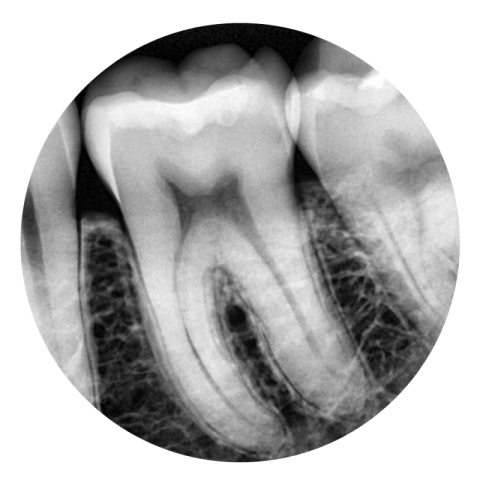 X Ray Teeth PNG Sticker Free Download